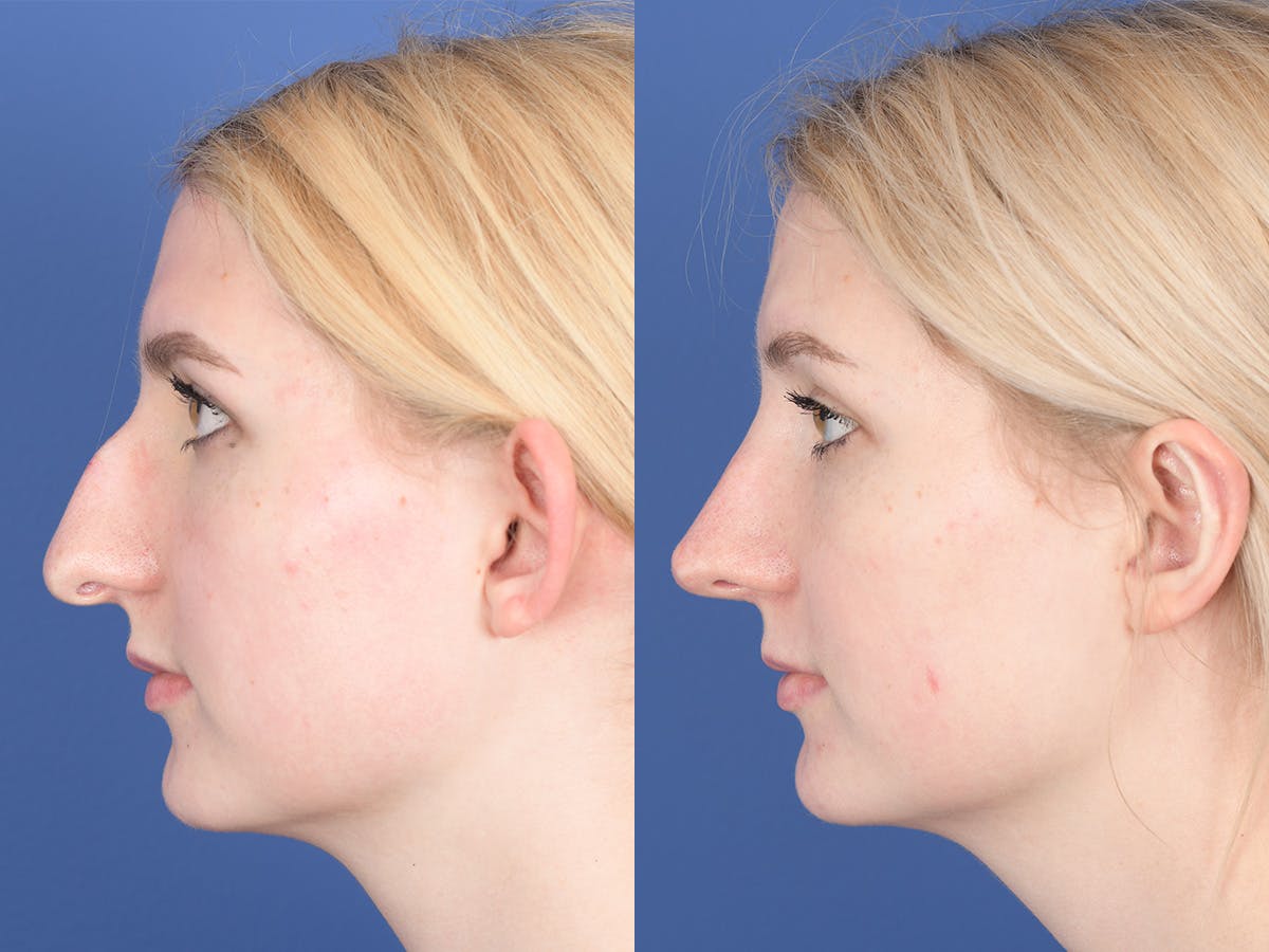 Rhinoplasty Before & After Gallery - Patient 255448 - Image 2