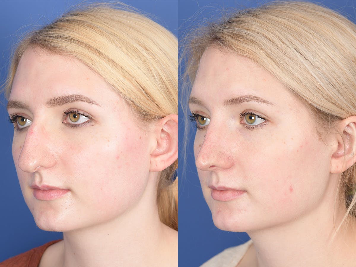 Rhinoplasty Before & After Gallery - Patient 255448 - Image 3