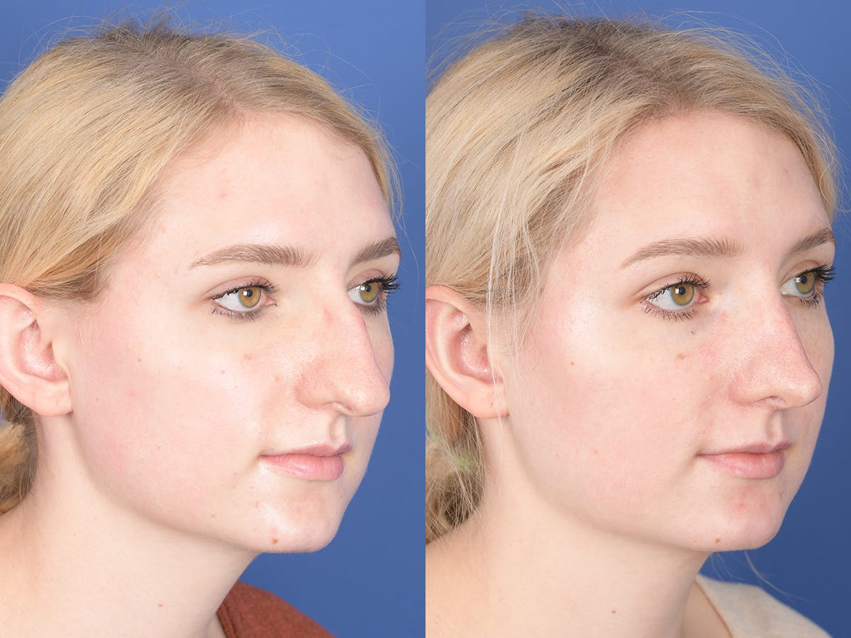 Rhinoplasty Before & After Gallery - Patient 255448 - Image 4