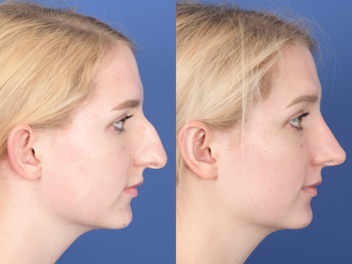 Rhinoplasty Before & After Gallery - Patient 255448 - Image 5