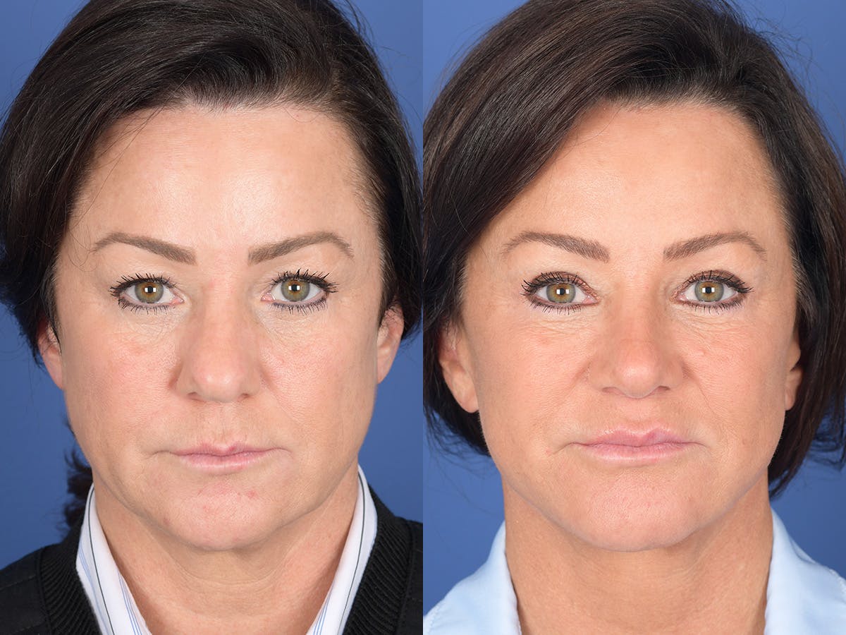 Rhinoplasty Before & After Gallery - Patient 211501 - Image 1