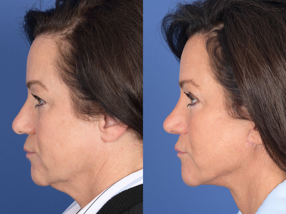 Rhinoplasty Before & After Gallery - Patient 211501 - Image 2