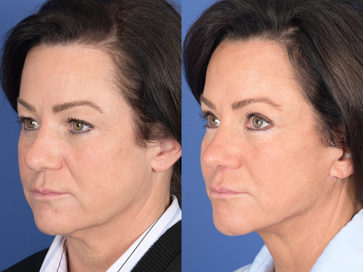 Rhinoplasty Before & After Gallery - Patient 211501 - Image 3