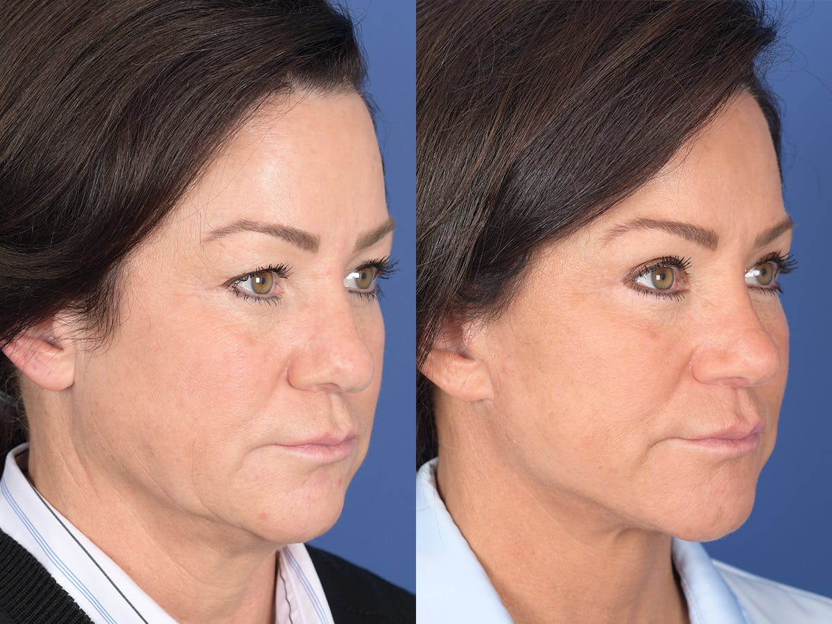 Rhinoplasty Before & After Gallery - Patient 211501 - Image 4