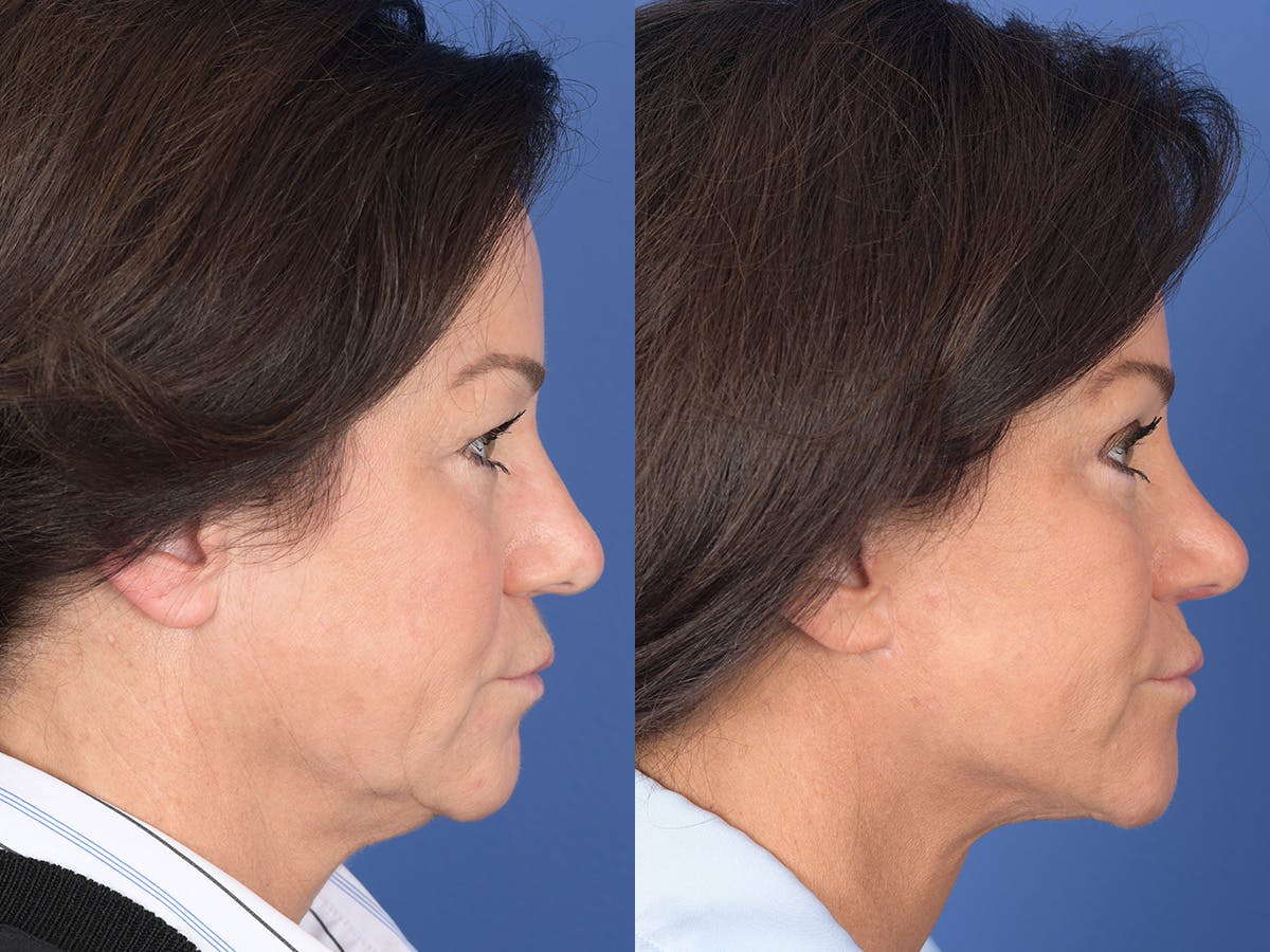 Rhinoplasty Before & After Gallery - Patient 211501 - Image 5