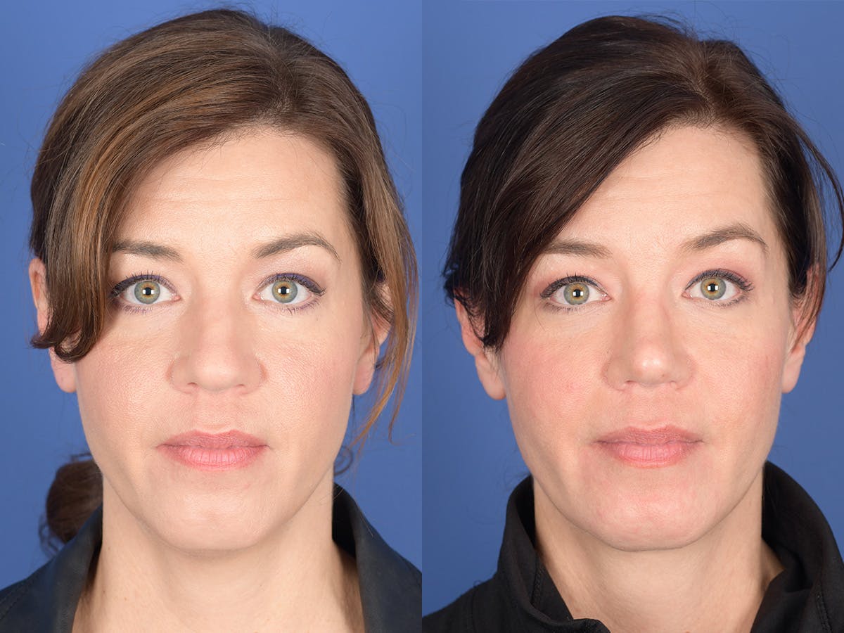 Rhinoplasty Before & After Gallery - Patient 103614 - Image 1