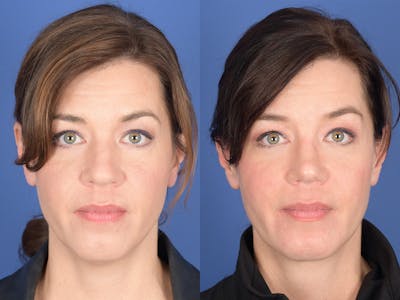 Rhinoplasty Before & After Gallery - Patient 103614 - Image 1