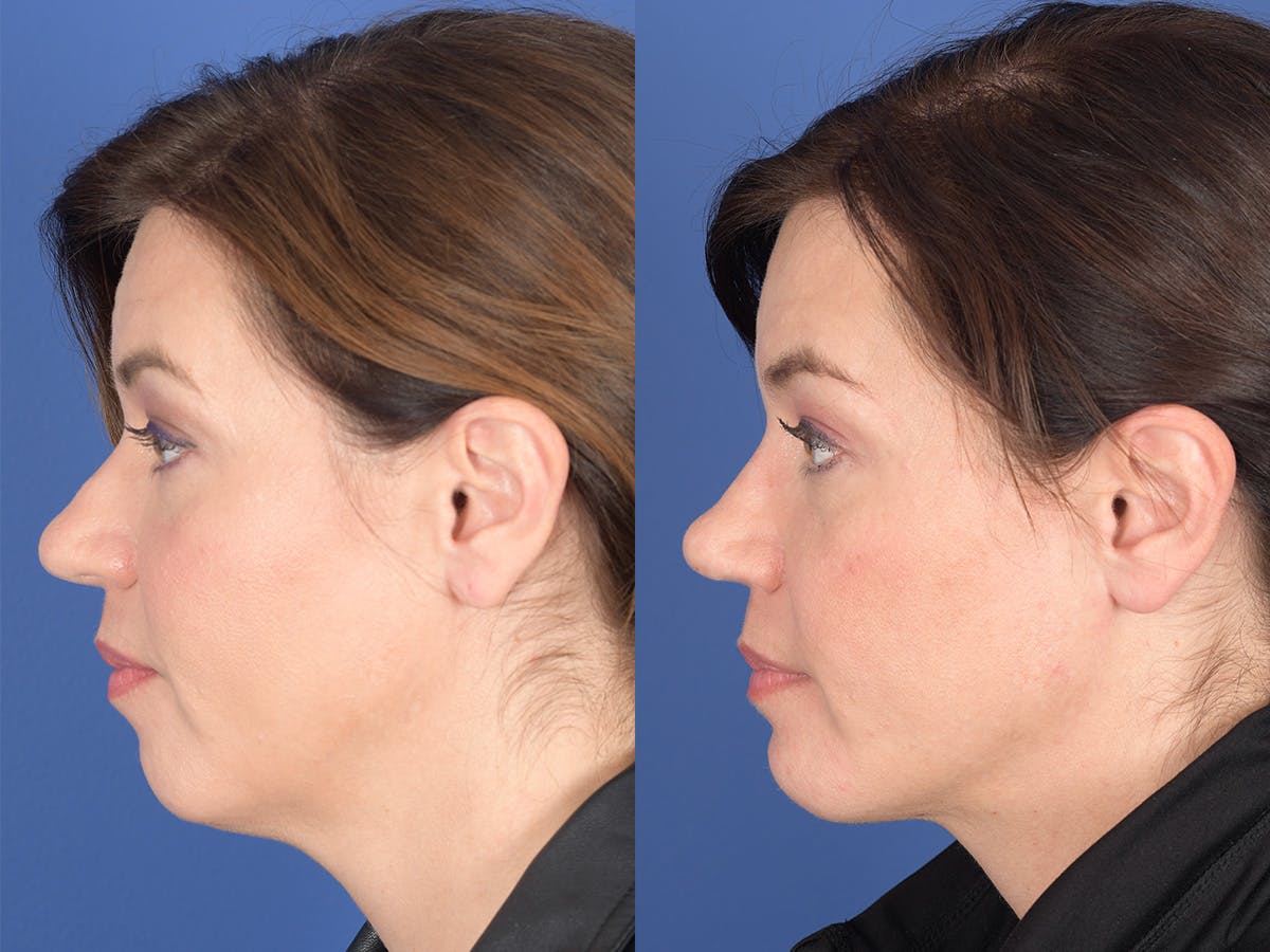 Rhinoplasty Before & After Gallery - Patient 103614 - Image 2