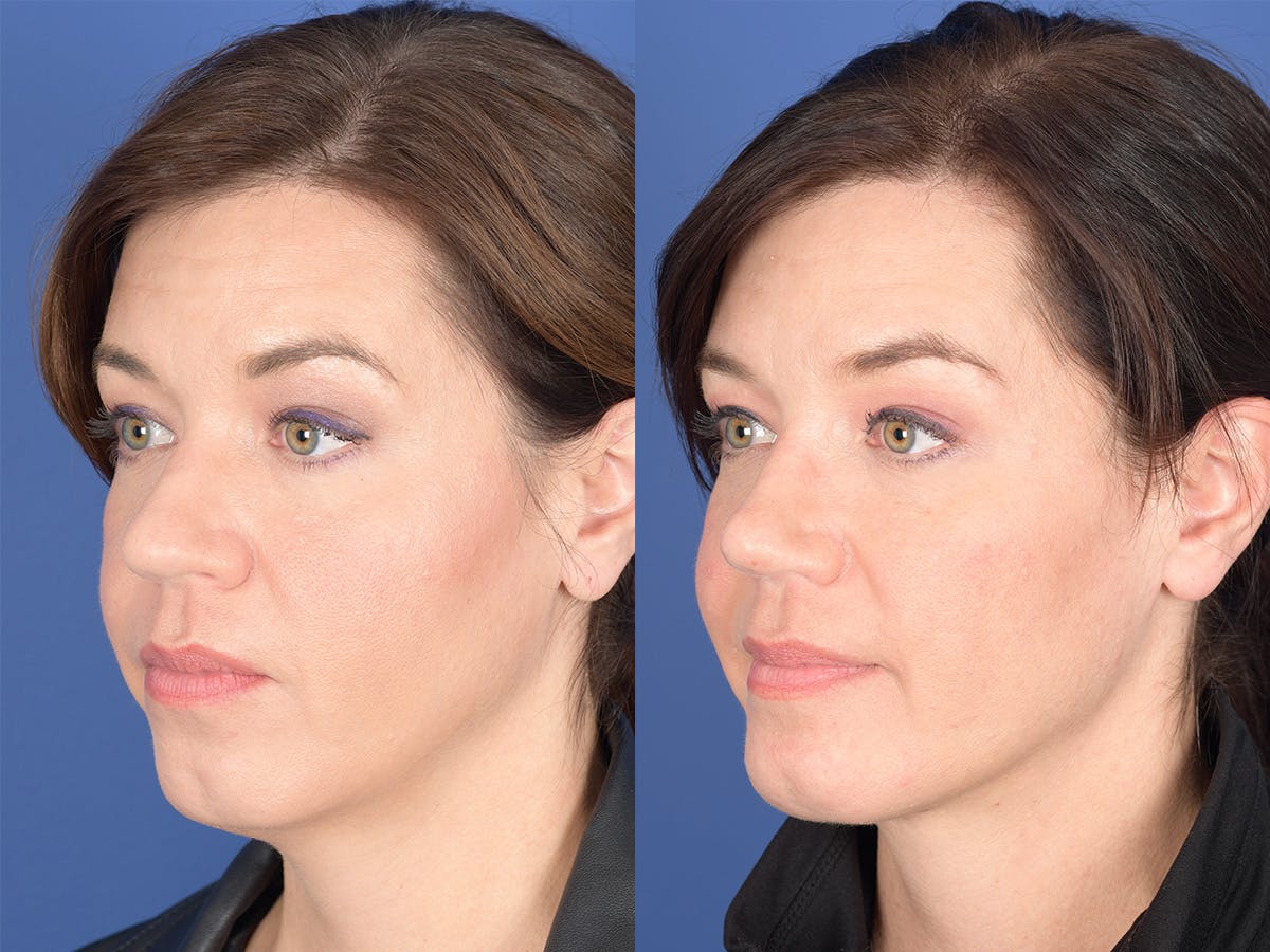 Rhinoplasty Before & After Gallery - Patient 103614 - Image 3