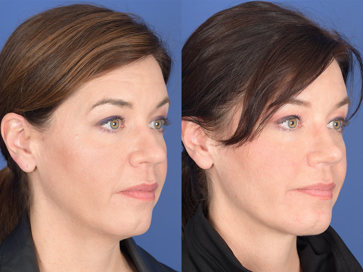 Rhinoplasty Before & After Gallery - Patient 103614 - Image 4