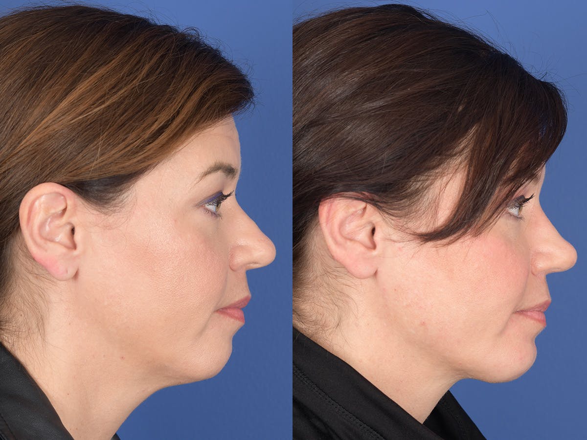 Rhinoplasty Before & After Gallery - Patient 103614 - Image 5