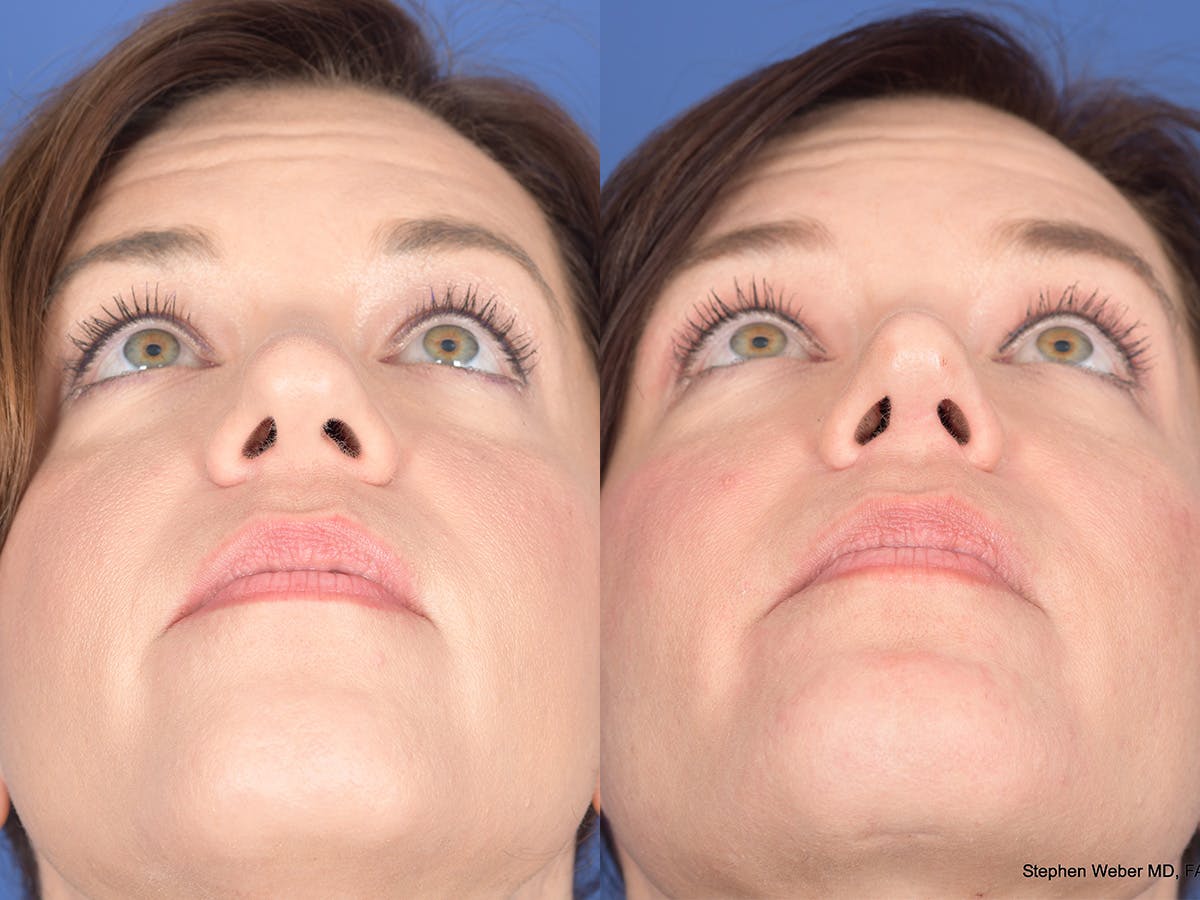 Rhinoplasty Before & After Gallery - Patient 103614 - Image 6