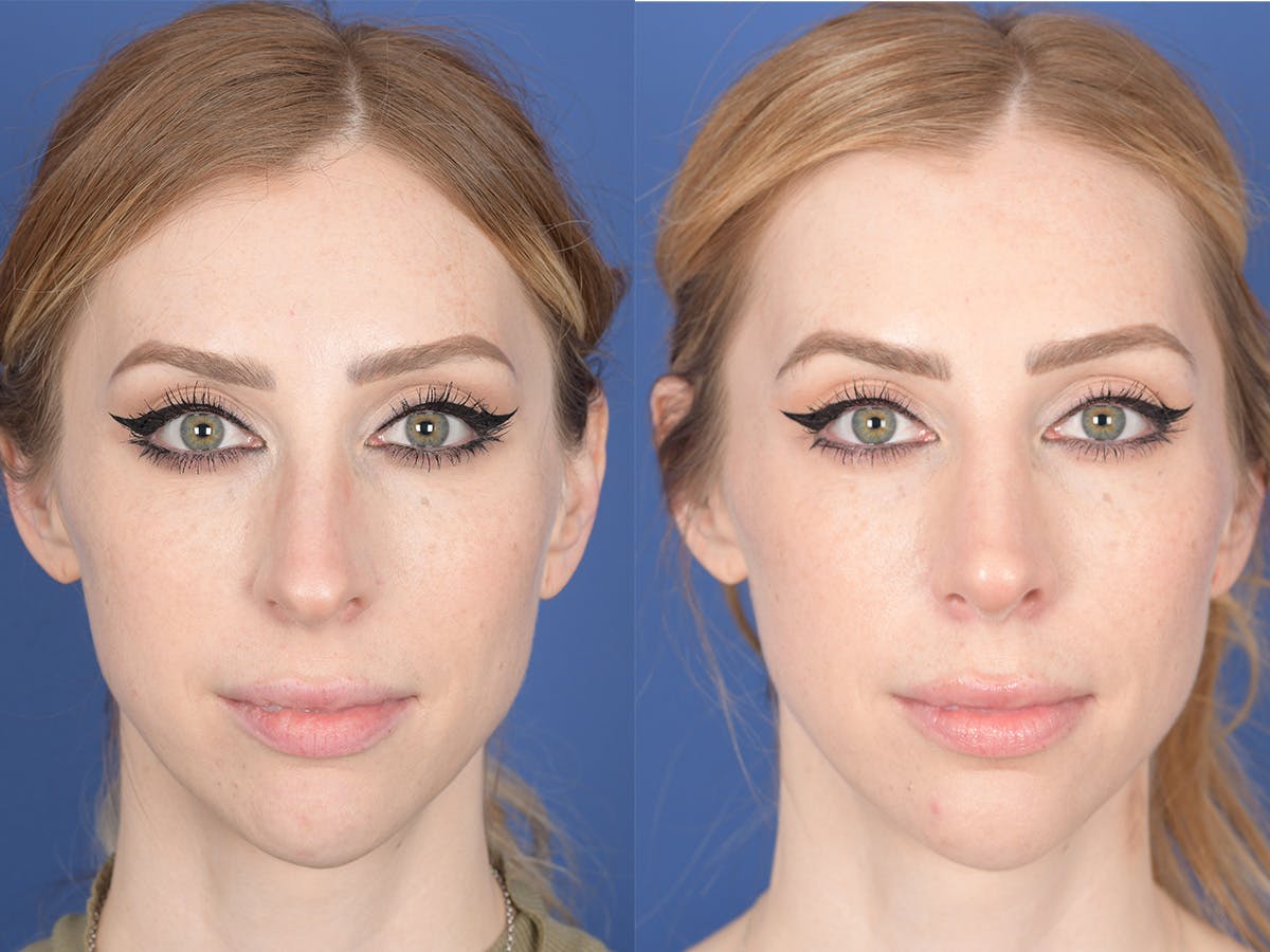 Rhinoplasty Before & After Gallery - Patient 336338 - Image 1