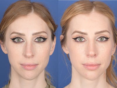 Rhinoplasty Before & After Gallery - Patient 336338 - Image 1