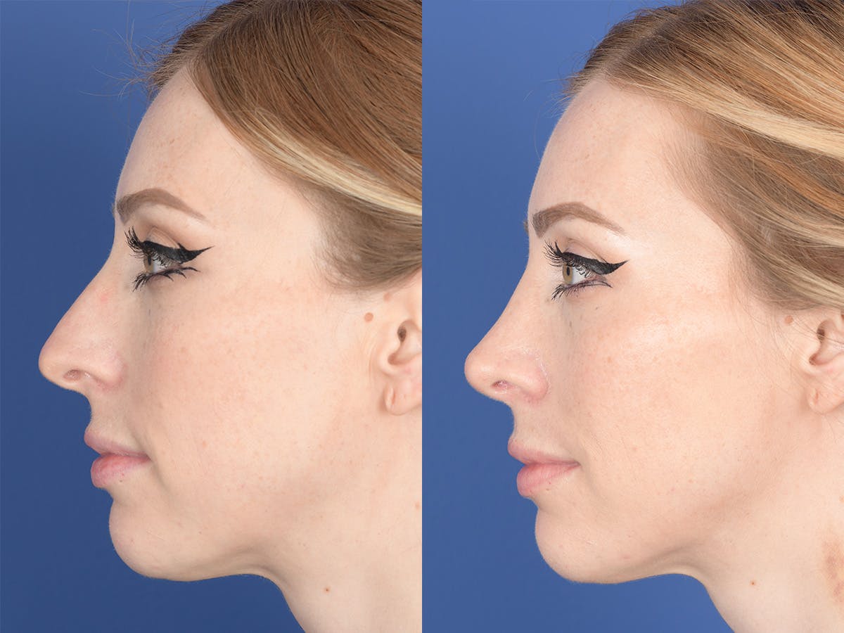Rhinoplasty Before & After Gallery - Patient 336338 - Image 2