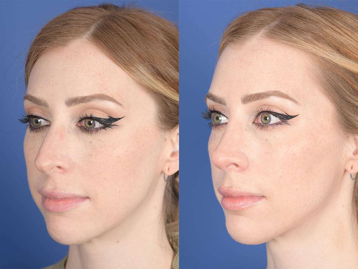 Rhinoplasty Before & After Gallery - Patient 336338 - Image 3
