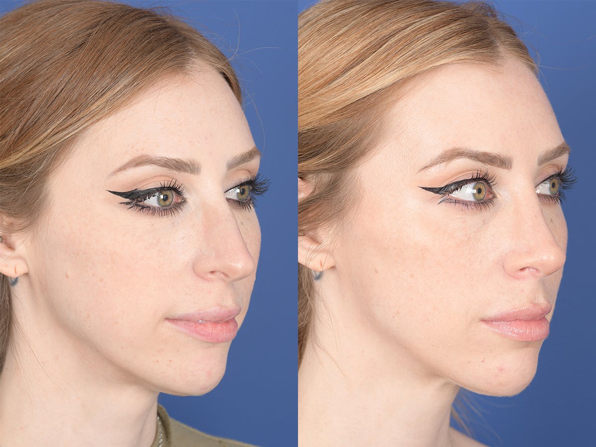 Rhinoplasty Before & After Gallery - Patient 336338 - Image 4