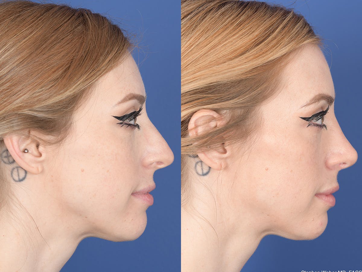 Rhinoplasty Before & After Gallery - Patient 336338 - Image 5