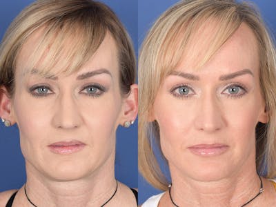 Rhinoplasty Before & After Gallery - Patient 974756 - Image 1