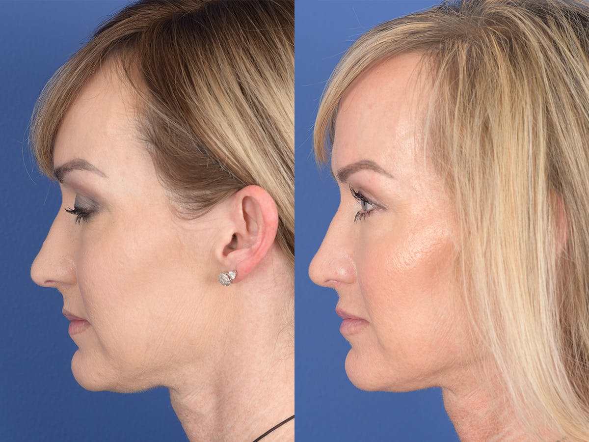 Rhinoplasty Before & After Gallery - Patient 974756 - Image 2