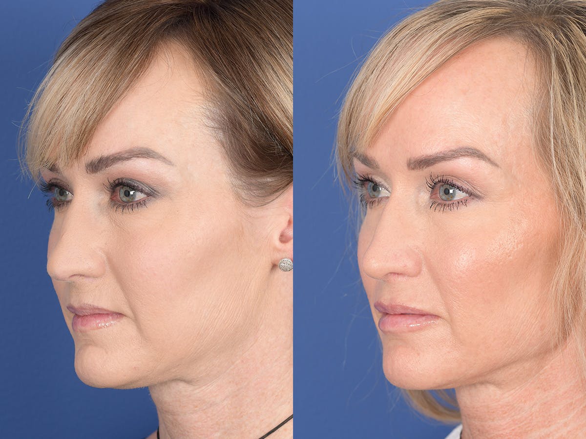 Rhinoplasty Before & After Gallery - Patient 974756 - Image 3