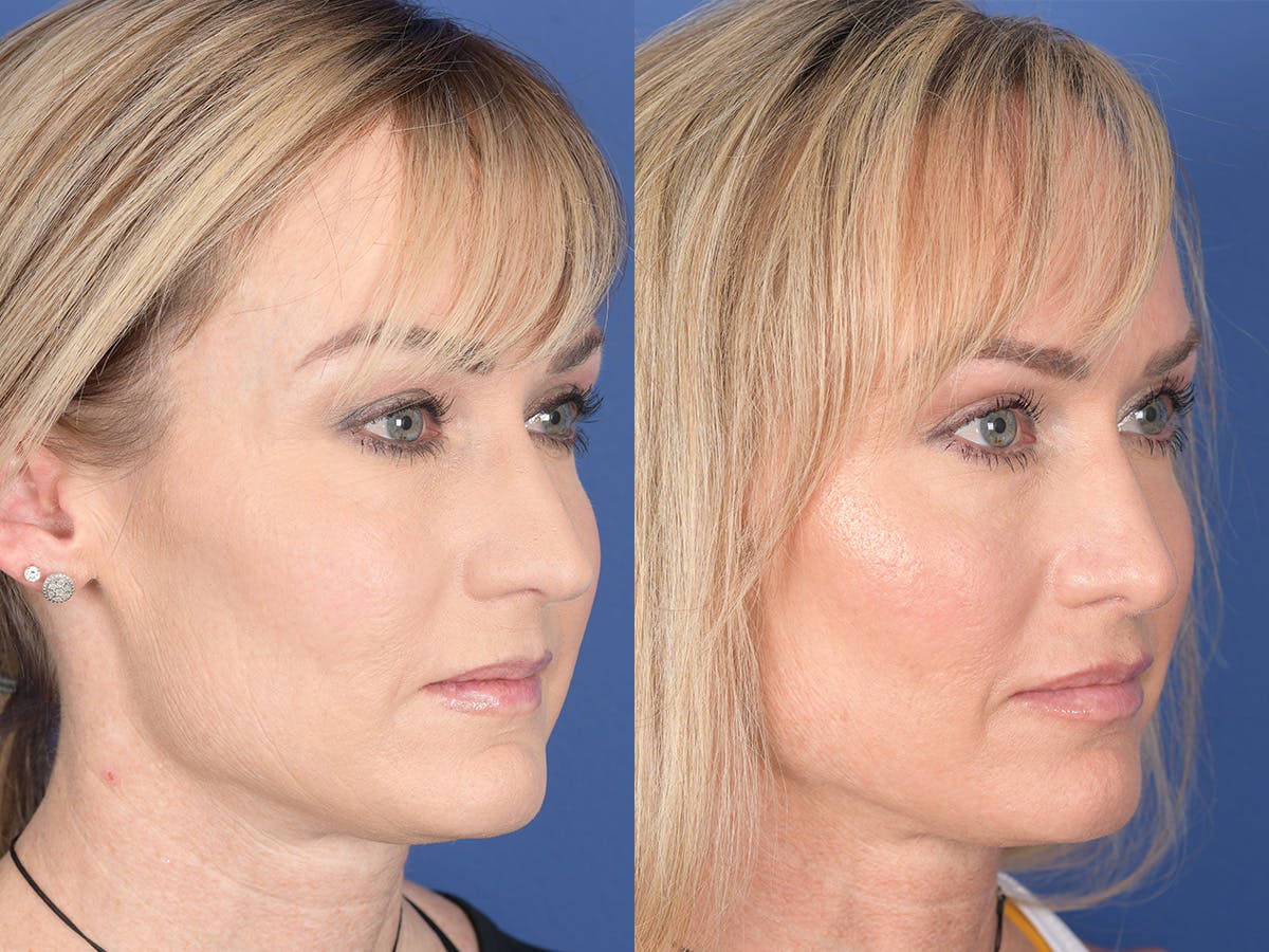 Rhinoplasty Before & After Gallery - Patient 974756 - Image 4