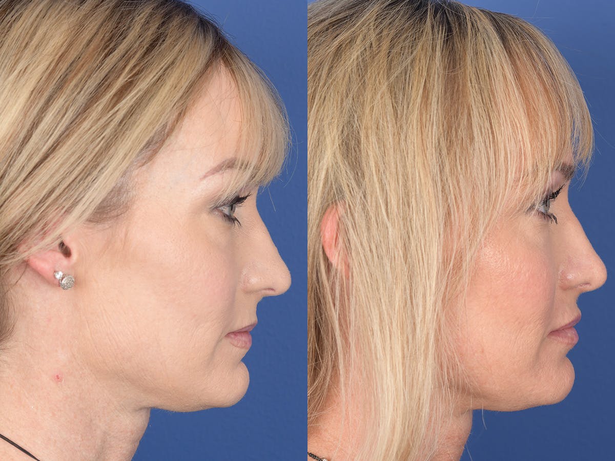 Rhinoplasty Before & After Gallery - Patient 974756 - Image 5