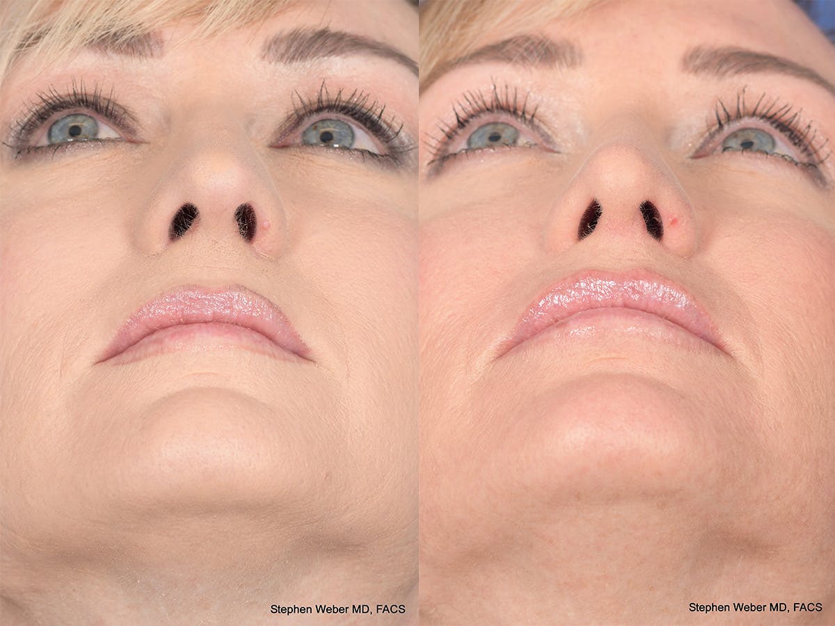 Rhinoplasty Before & After Gallery - Patient 974756 - Image 6