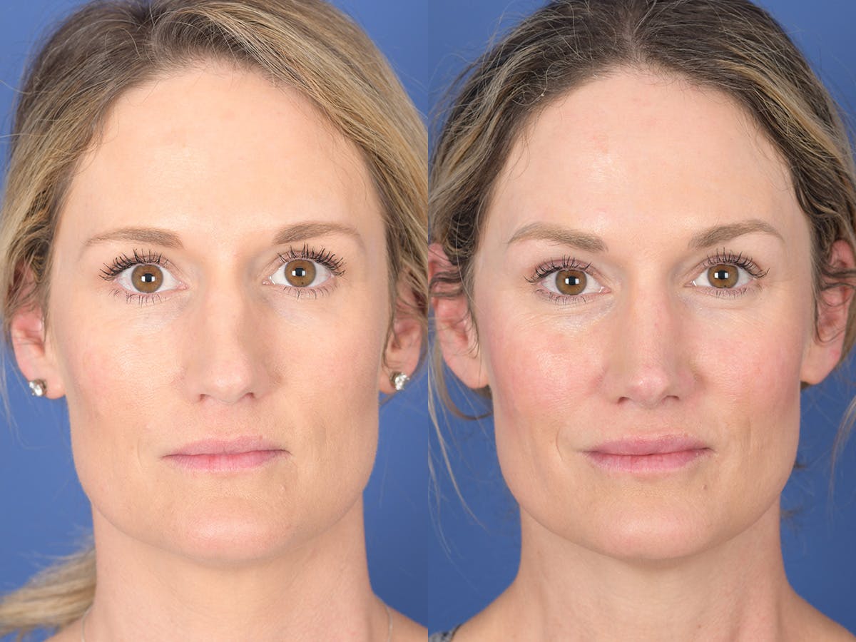 Rhinoplasty Before & After Gallery - Patient 254747 - Image 1