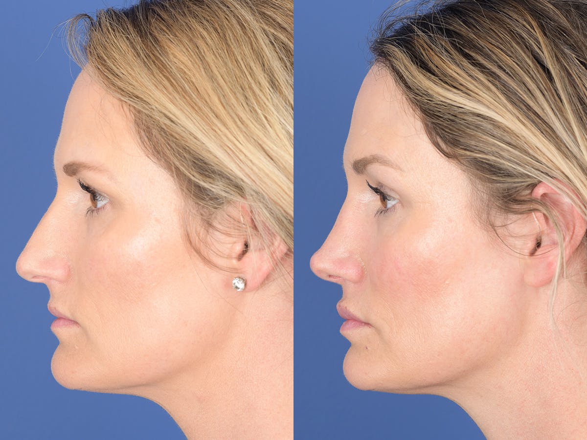 Rhinoplasty Before & After Gallery - Patient 254747 - Image 2