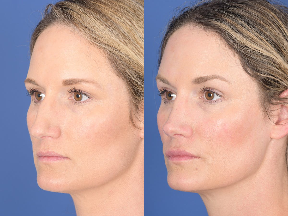 Rhinoplasty Before & After Gallery - Patient 254747 - Image 3