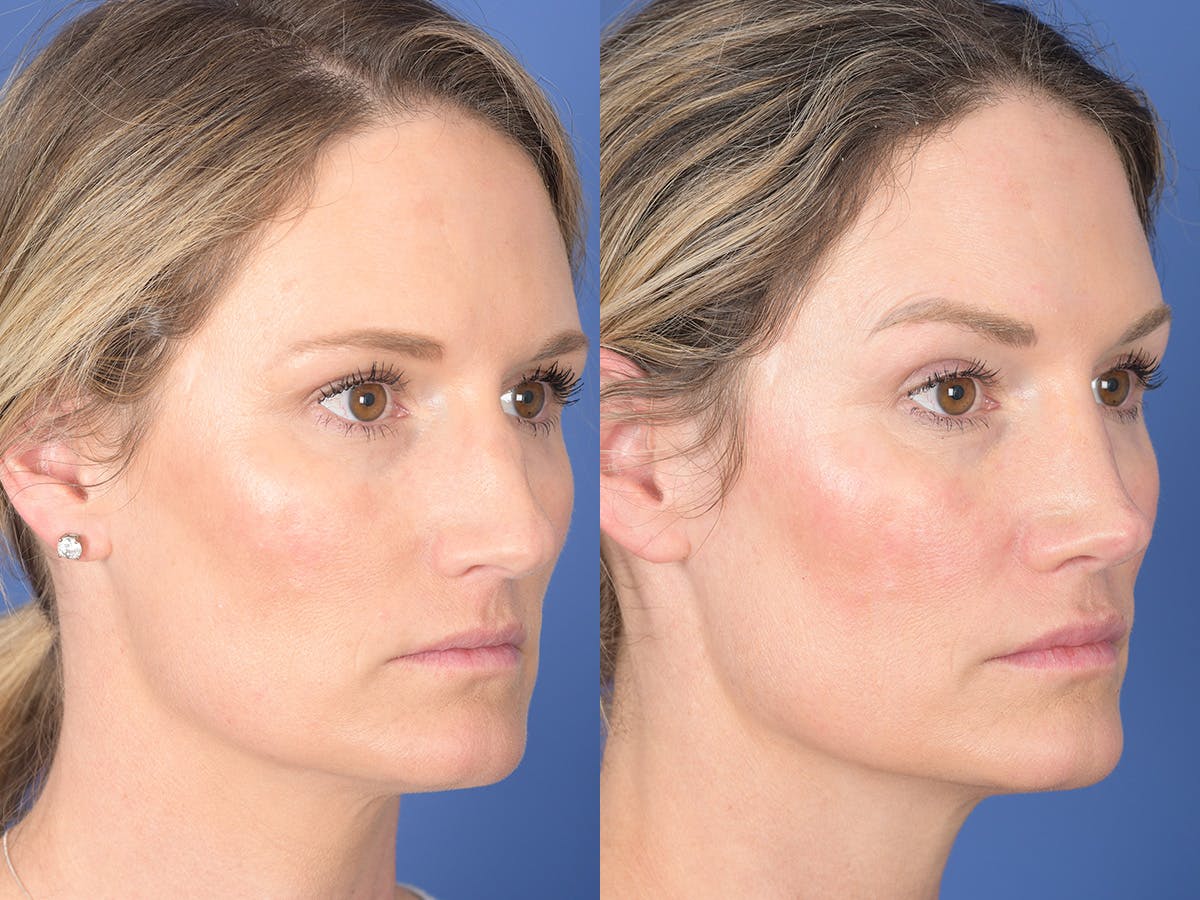 Rhinoplasty Before & After Gallery - Patient 254747 - Image 4