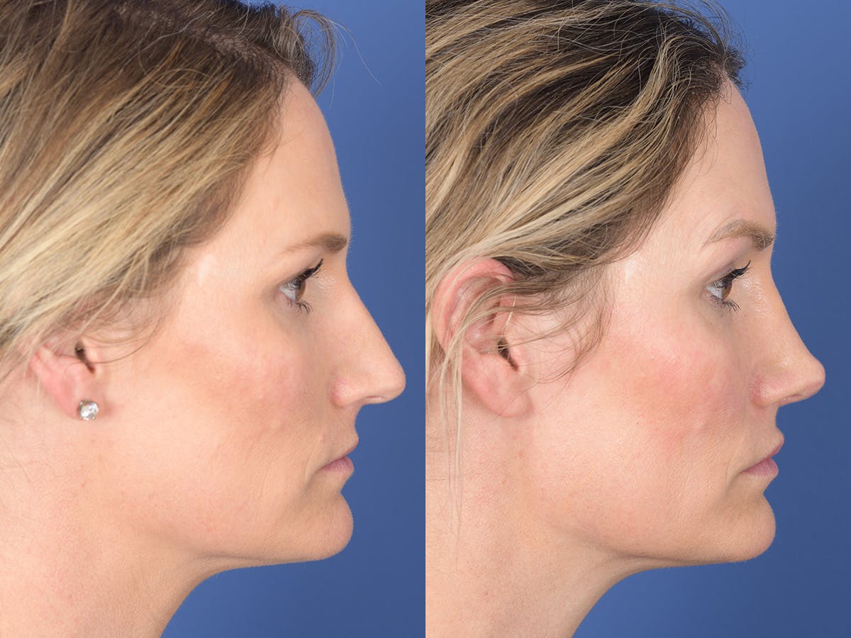 Rhinoplasty Before & After Gallery - Patient 254747 - Image 5