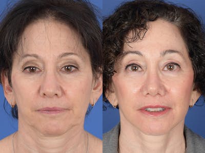 Rhinoplasty Before & After Gallery - Patient 409083 - Image 1