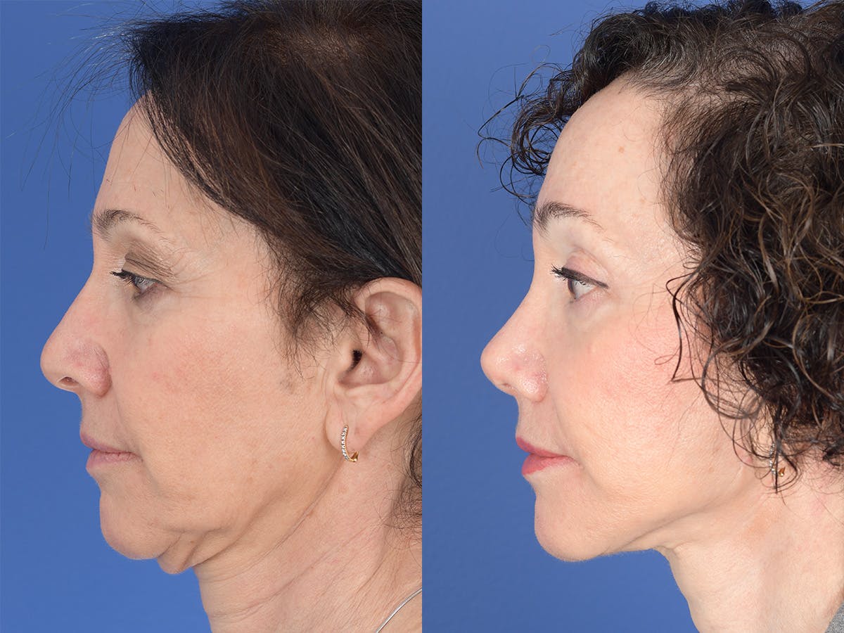 Rhinoplasty Before & After Gallery - Patient 409083 - Image 2