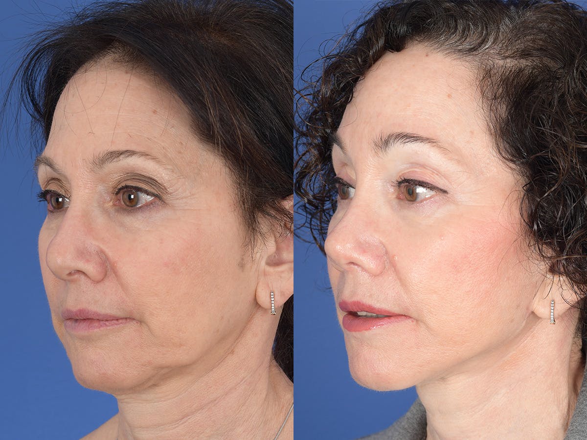 Rhinoplasty Before & After Gallery - Patient 409083 - Image 3