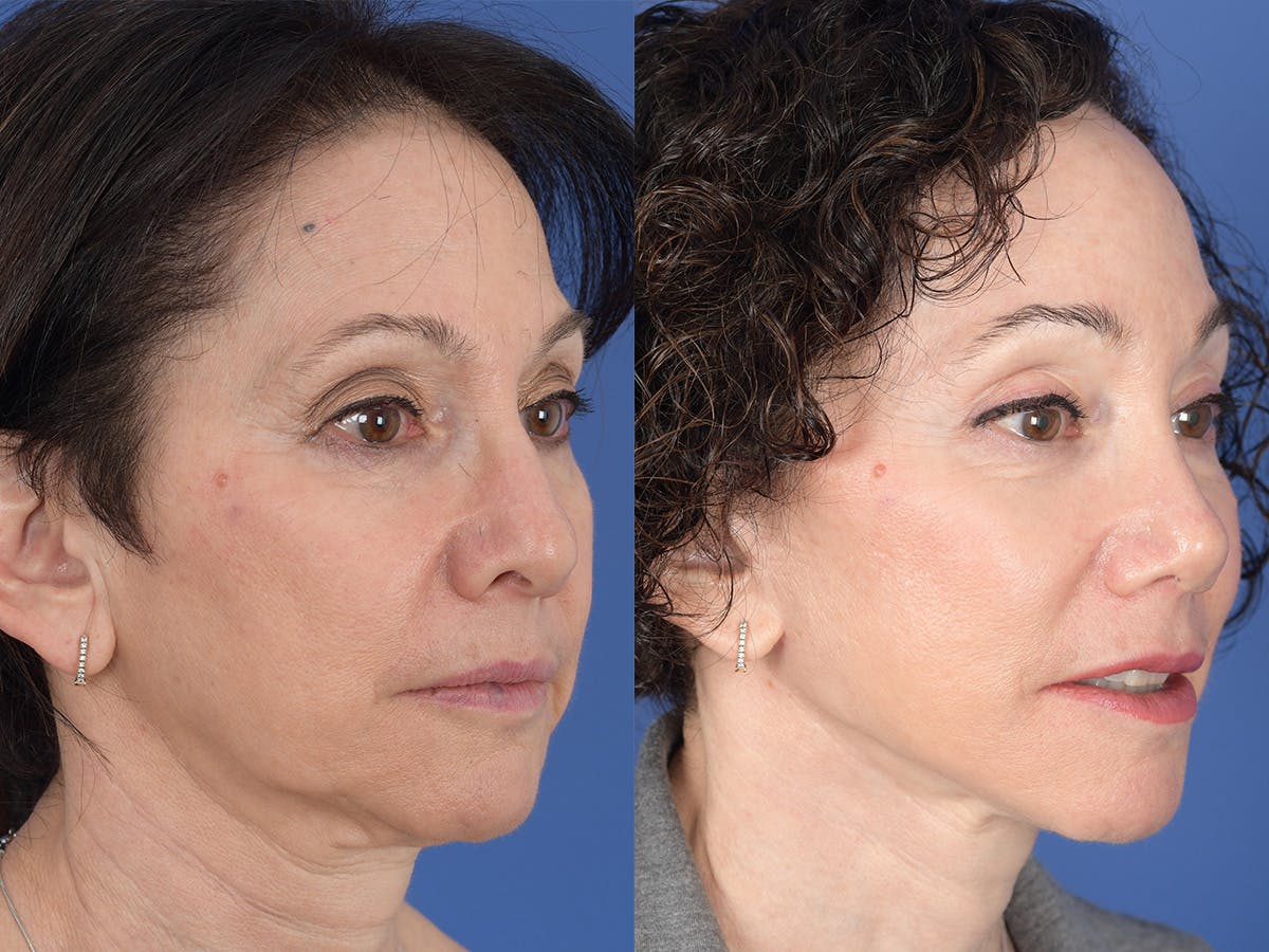 Rhinoplasty Before & After Gallery - Patient 409083 - Image 4