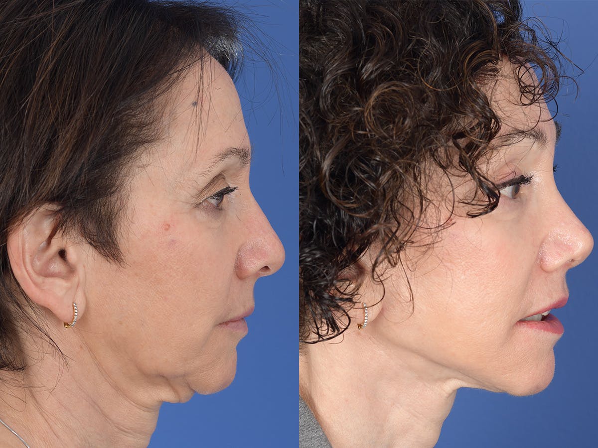 Rhinoplasty Before & After Gallery - Patient 409083 - Image 5