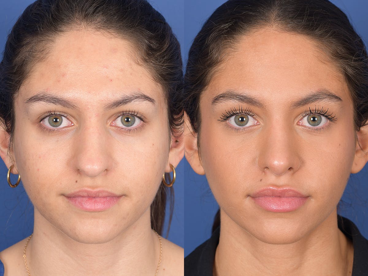 Rhinoplasty Before & After Gallery - Patient 349119 - Image 1