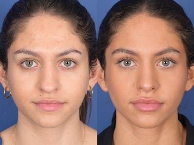 Rhinoplasty Before & After Gallery - Patient 349119 - Image 1
