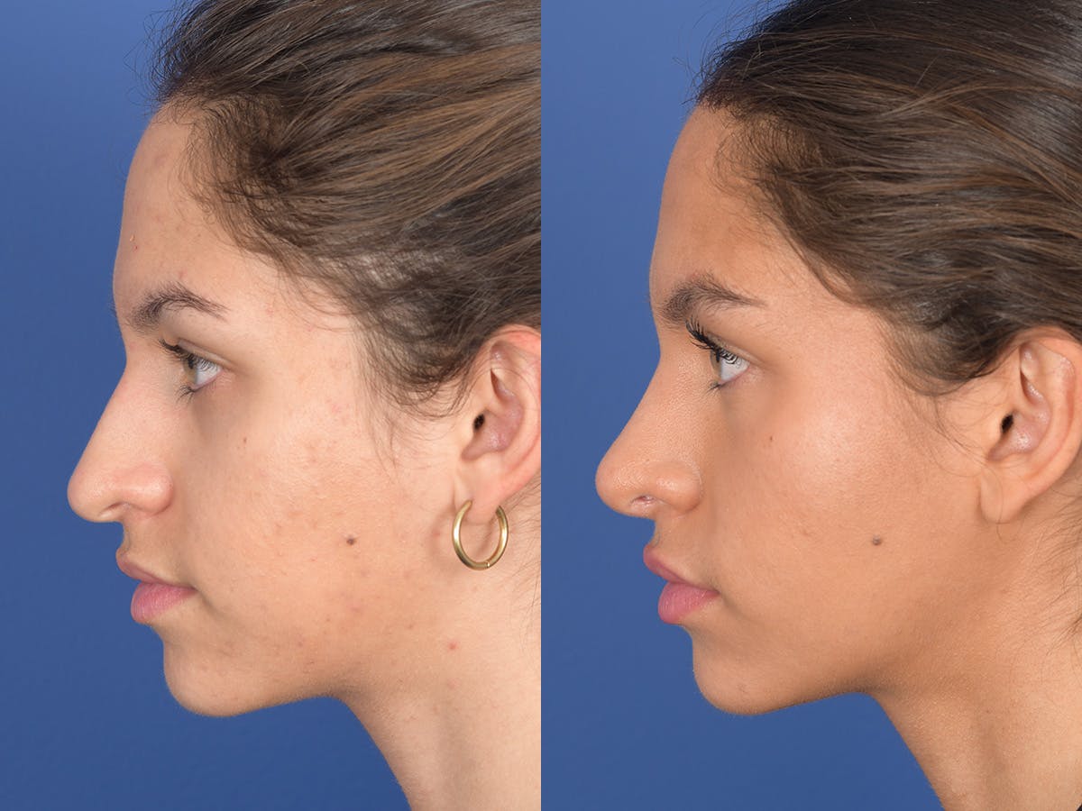 Rhinoplasty Before & After Gallery - Patient 349119 - Image 2