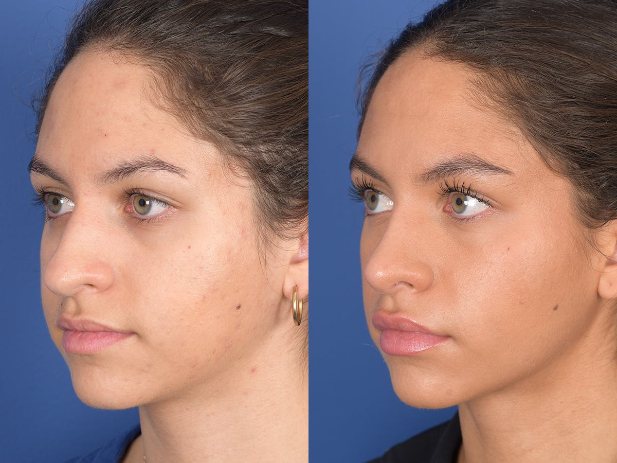 Rhinoplasty Before & After Gallery - Patient 349119 - Image 3
