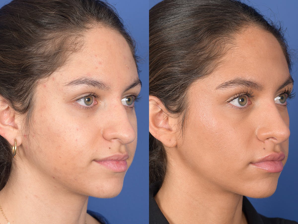 Rhinoplasty Before & After Gallery - Patient 349119 - Image 4