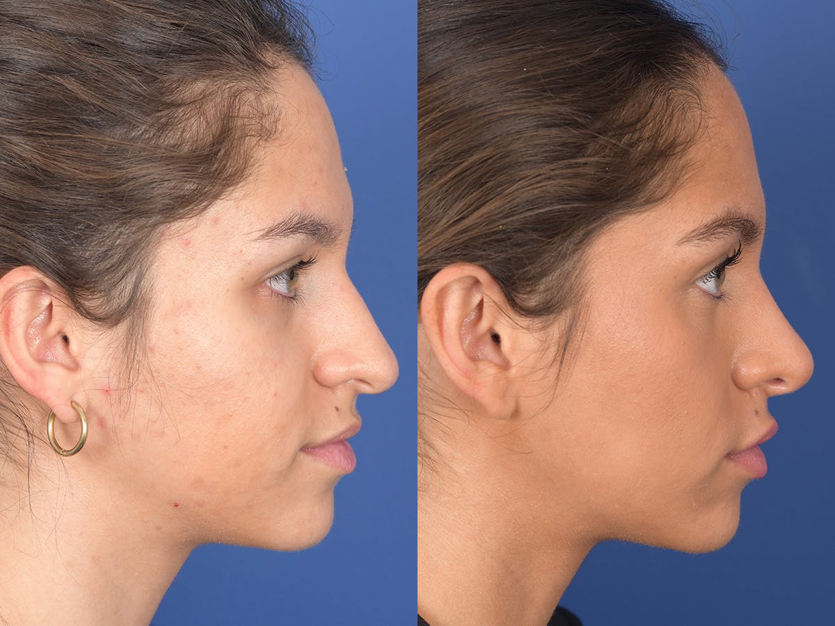 Rhinoplasty Before & After Gallery - Patient 349119 - Image 5