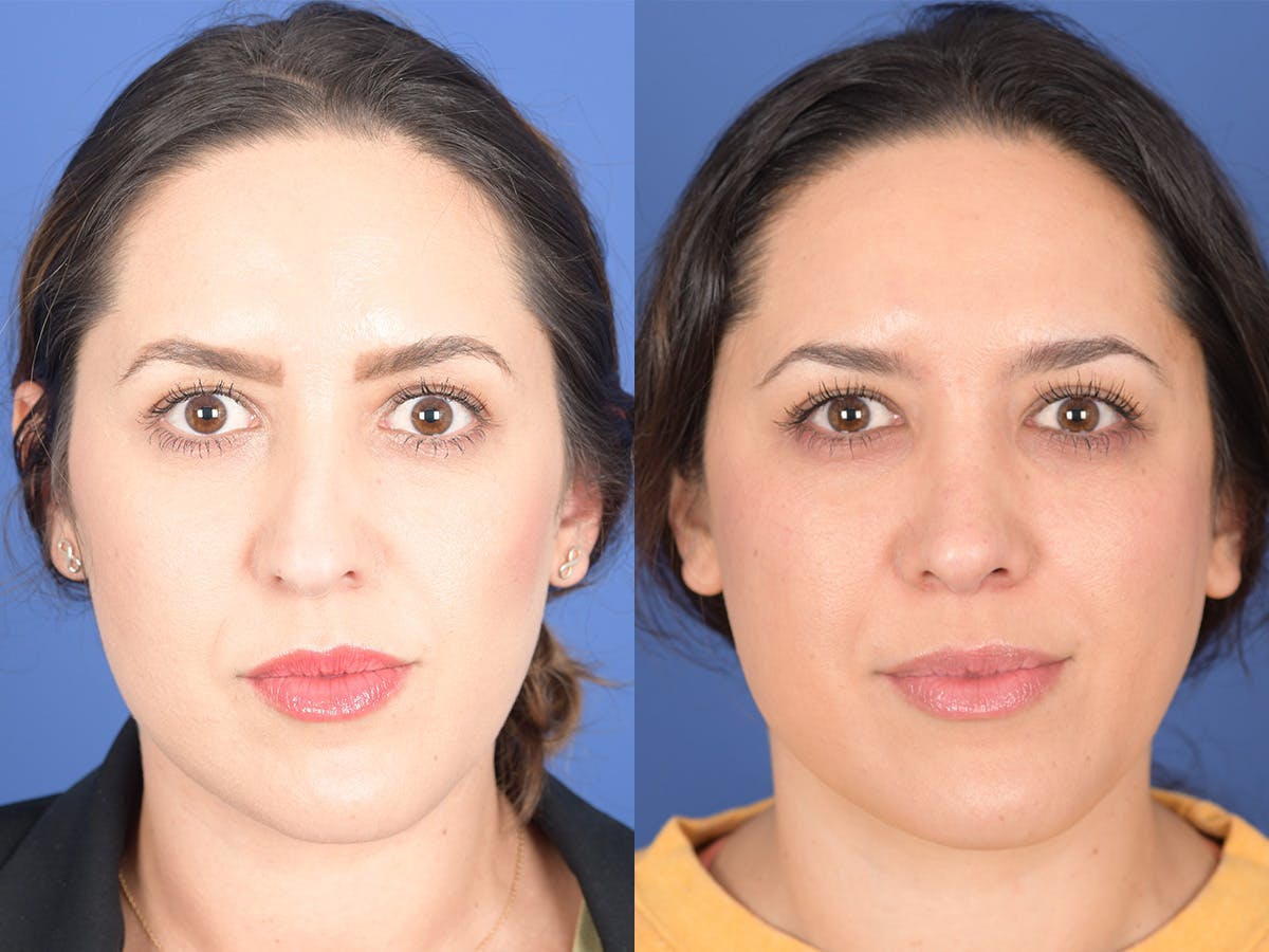 Rhinoplasty Before & After Gallery - Patient 762511 - Image 1