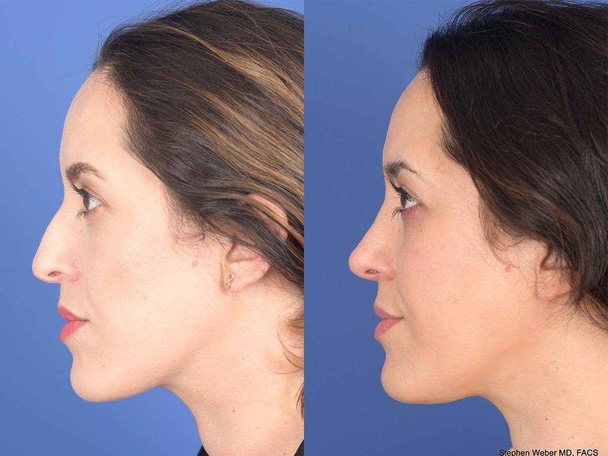Rhinoplasty Before & After Gallery - Patient 762511 - Image 2