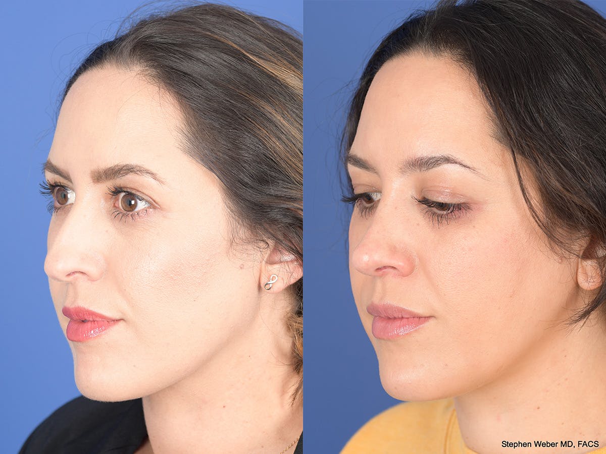 Rhinoplasty Before & After Gallery - Patient 762511 - Image 3