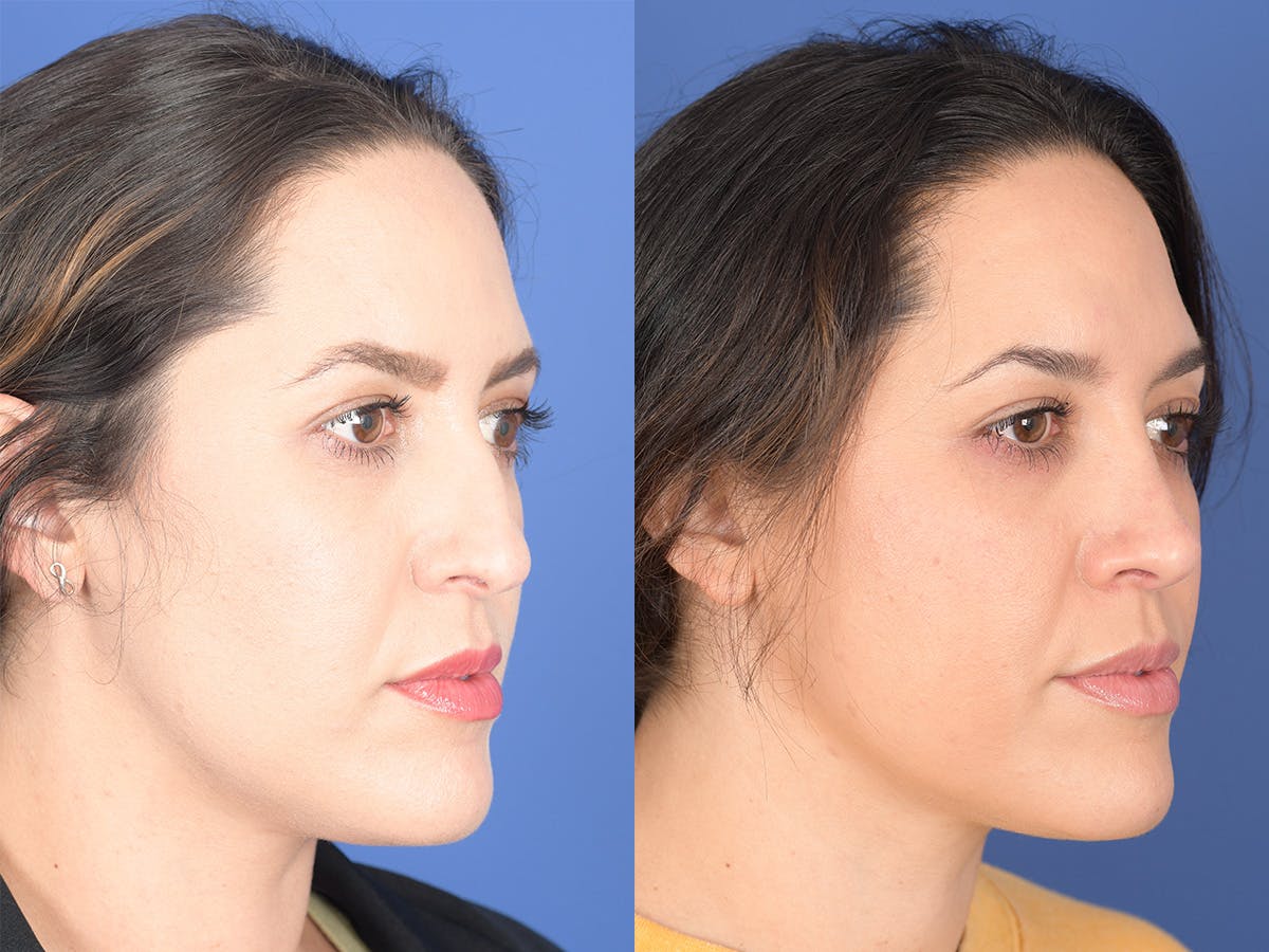 Rhinoplasty Before & After Gallery - Patient 762511 - Image 4