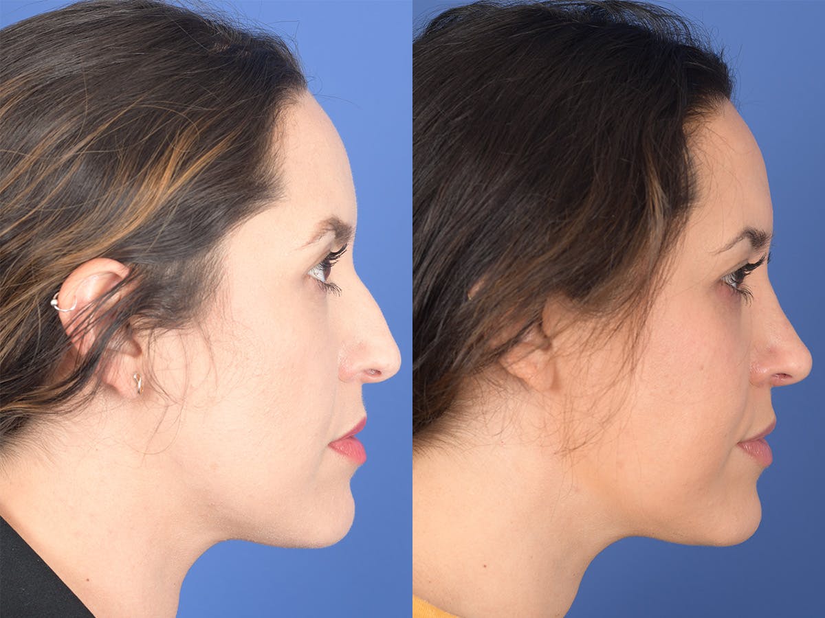 Rhinoplasty Before & After Gallery - Patient 762511 - Image 5