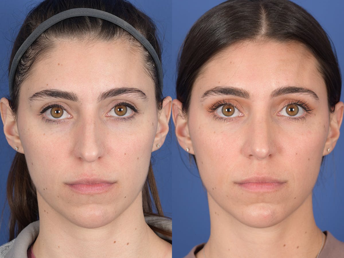 Rhinoplasty Before & After Gallery - Patient 726862 - Image 1